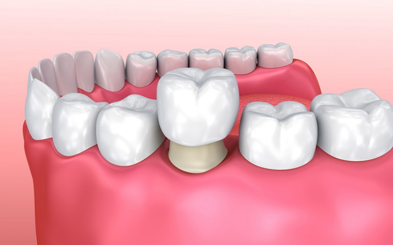 Răng sâu nặng có bọc sứ được không? – Chuyên gia giải đáp