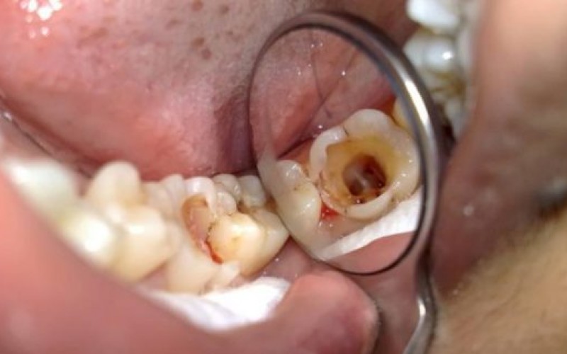 Có nên nhổ răng bị chết tủy không?